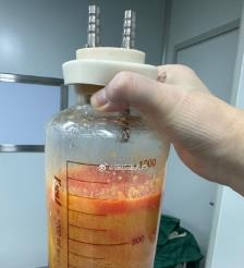 嘉峪关水动力吸脂手术要做多久？